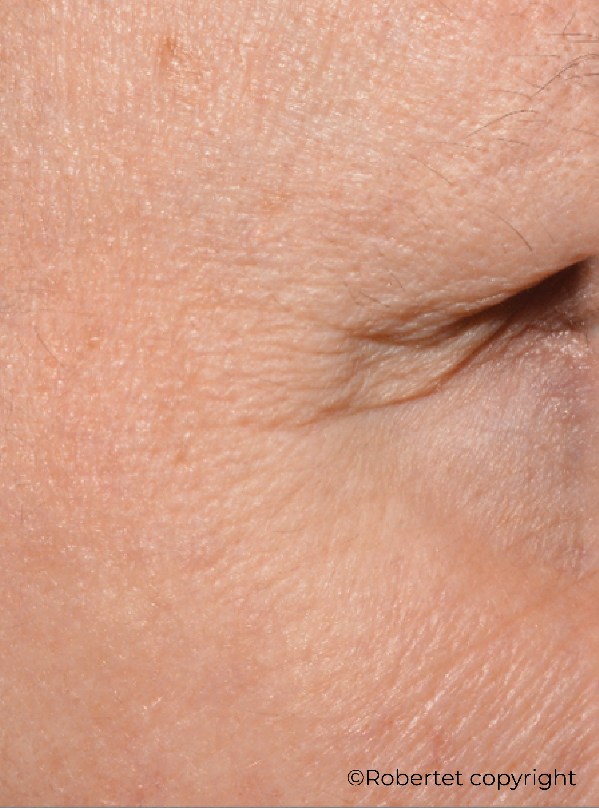 Before-after-wrinkles-Lipowheat-Robertet.png