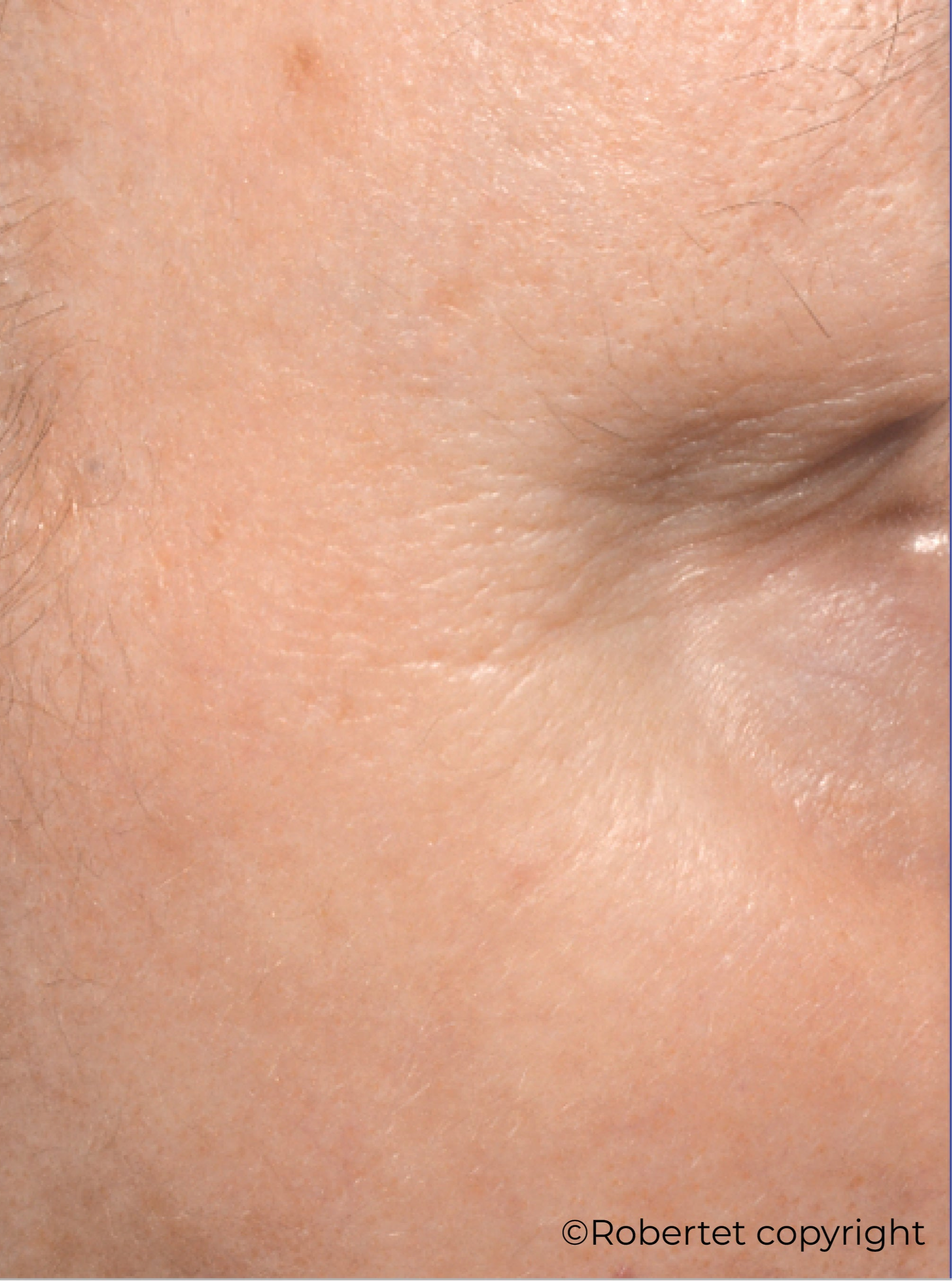 Before-after-wrinkles-Lipowheat-Robertet_21b53acc-3229-4557-b54f-2914baa6327e.png